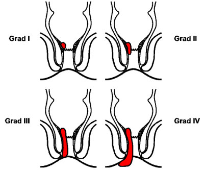 haemoriden grad